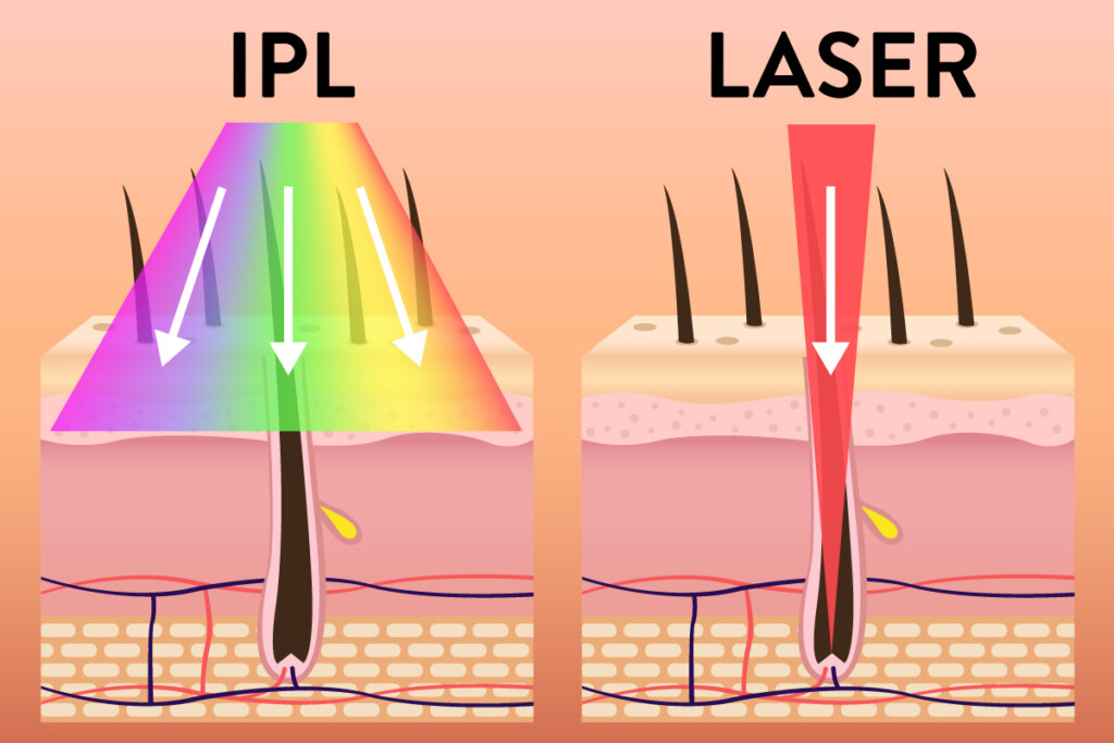 ipl_and_laser