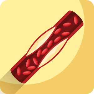 Arteriosclerosi